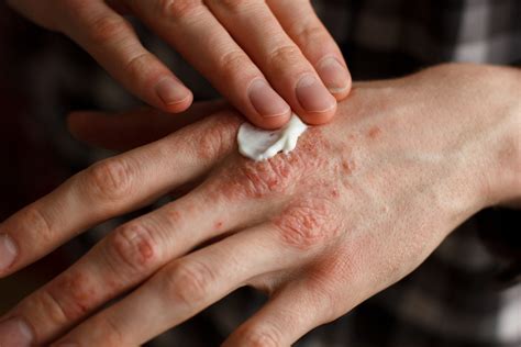 Psoriasis Treatment from a Dermatologist | Dermatology Associates of Plymouth Meeting
