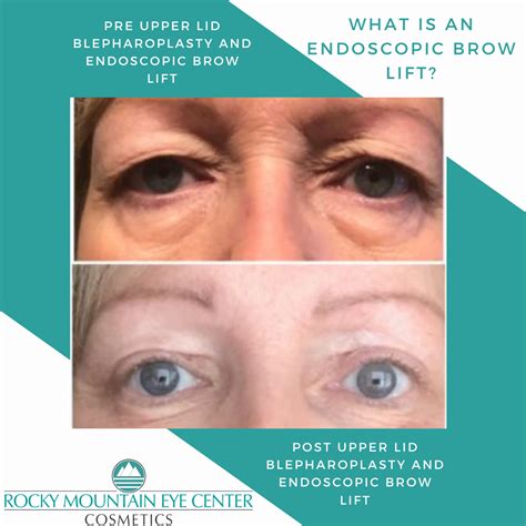 Endoscopic Brow Lift | Endoscopic brow lift, Brow lift, Brows