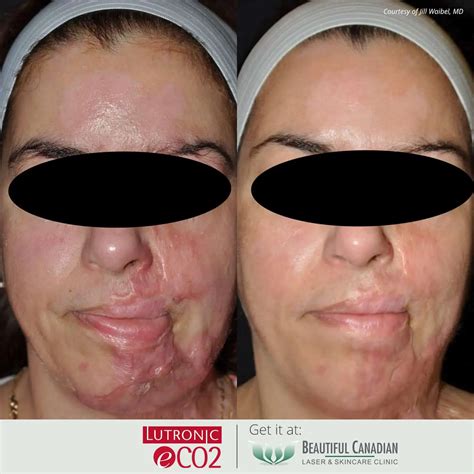 Laser Skin Treatment For Burn Scars at Phyllis Fetter blog