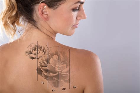 Laser Tattoo Removal - Schweiger Dermatology Group