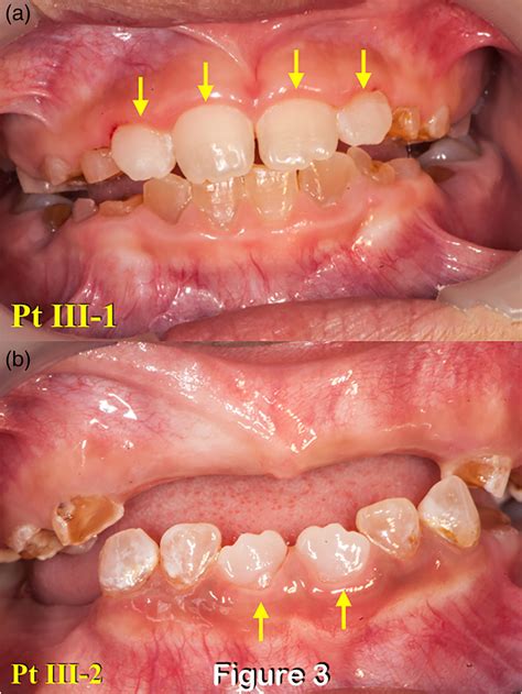 Dentinogenesis Imperfecta