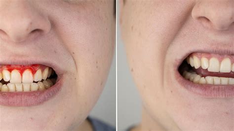 Does Gum Disease Last Forever at Jane Mcgary blog