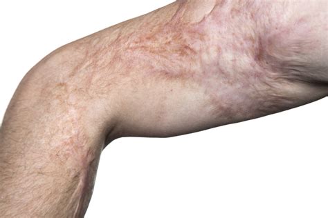 Burns, Part 2: Third-Degree Injuries