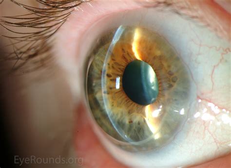 Corneal Transplant Stitches