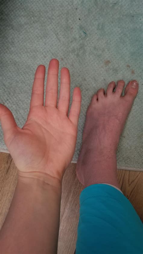 Blood Pooling is Real : r/POTS