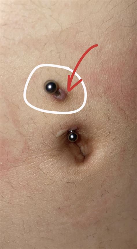 Keloid Scarring Belly Button Piercing