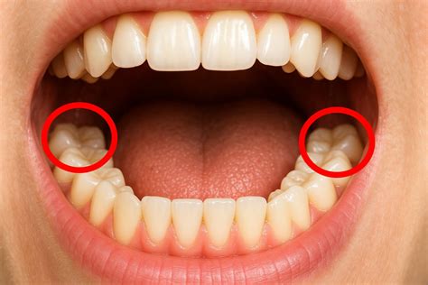 Muelas del juicio: qué son, cuándo salen y cuándo conviene extraerlas ...