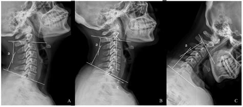 Preoperative Decreased Hounsfield Unit Values of Cervical Vertebrae and ...