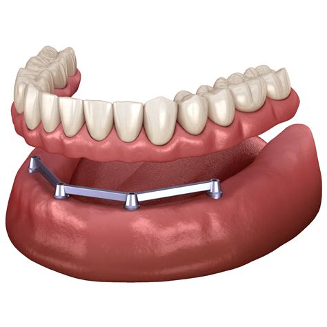 Implant-Retained Dentures | Low-Cost Implant Alternative