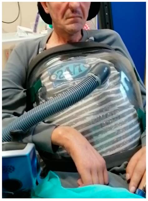 Negative-Pressure Ventilation in Neuromuscular Diseases in the Acute ...