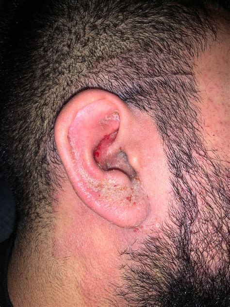 As you can see from the picture really bad dryness around ears. Cerave lotion is the only thing ...