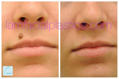 This young lady had a mole removed from her upper lip and is shown ...