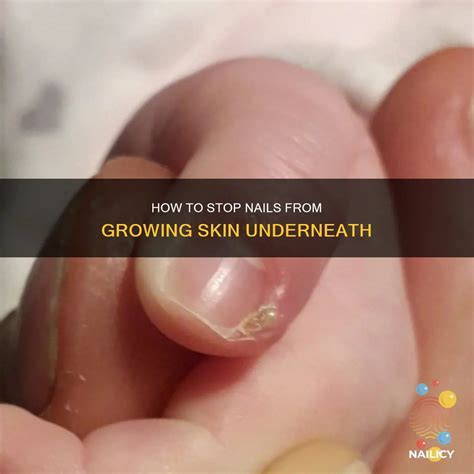 How To Stop Nails From Growing Skin Underneath | Nailicy