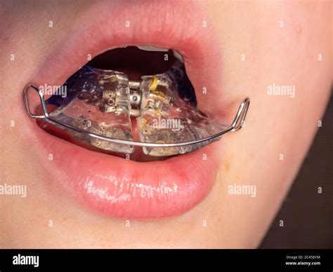 Removable Palatal Expander