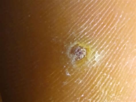 Hole in foot : r/DiagnoseMe