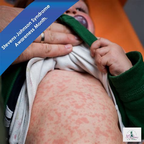 *** Johnson Syndrome After