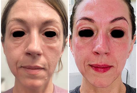 Microneedling before and after - undereye help? [Anti-aging] : r/SkincareAddiction