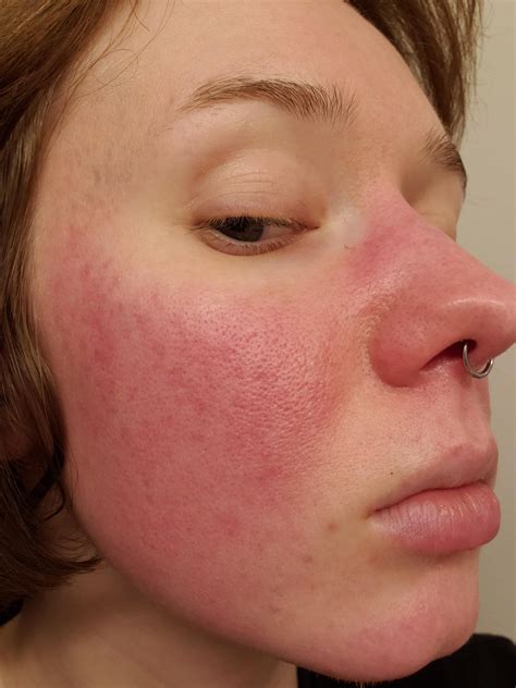 Weird redness / rash? on cheeks, nose and chin? : r/Skincare_Addiction