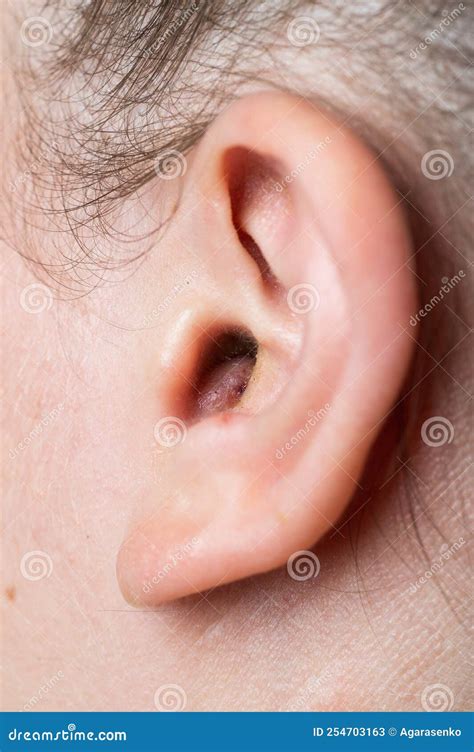 Abscess Earlobe at James Engel blog
