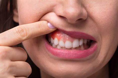 Why Are My Teeth Sensitive Gums at Gary Horton blog