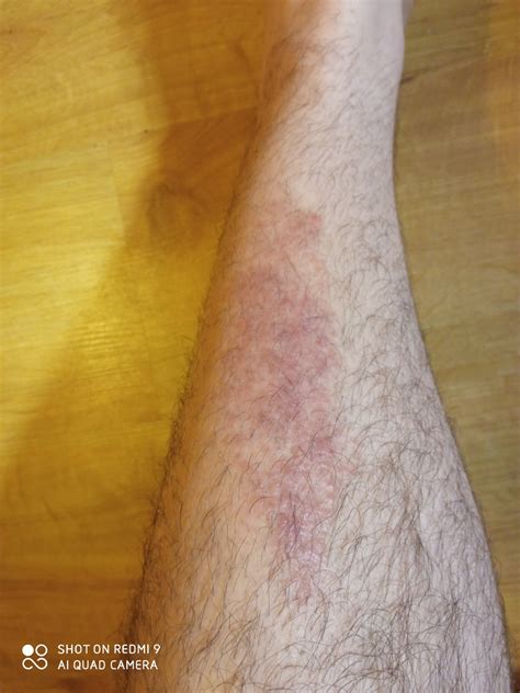 Атопический дерматит чем лечить? - Вопрос дерматологу - 03 Онлайн