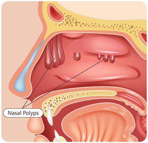 Why do I often have stuffy nose (nasal congestion) when lying down? How ...