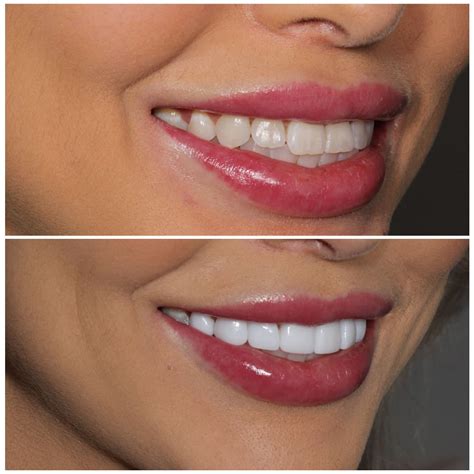 Veneers Before And After On Crooked Teeth at Collette Brown blog