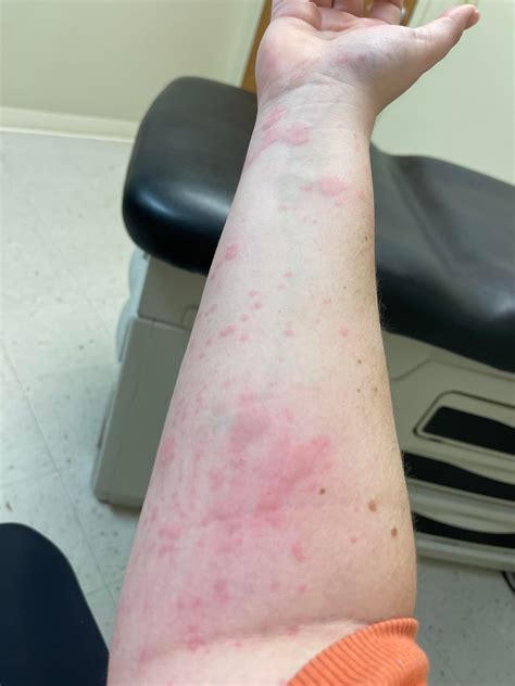 Hives for almost three weeks : r/urticaria