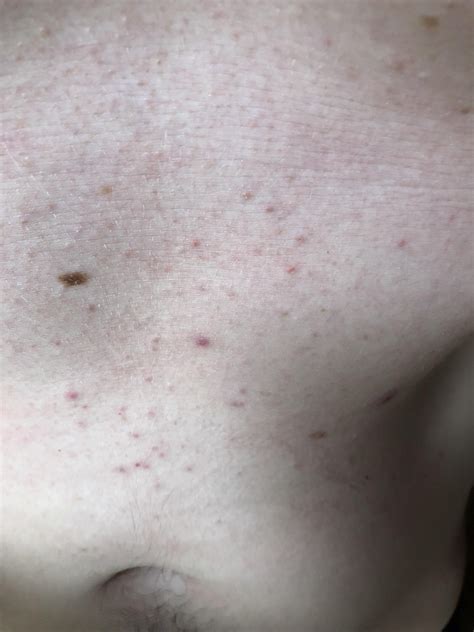 32/M is this acne? Stomach photo of bumps that have been around for three months : r/acne