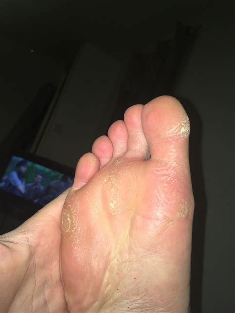 I keep getting intermittent burning sensation In the soles of my feet and constantly have dry ...