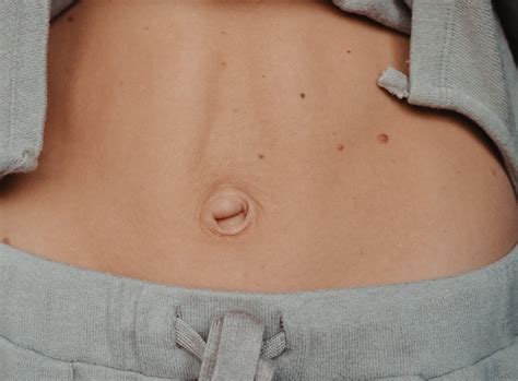 Hernia In Women Abdomen