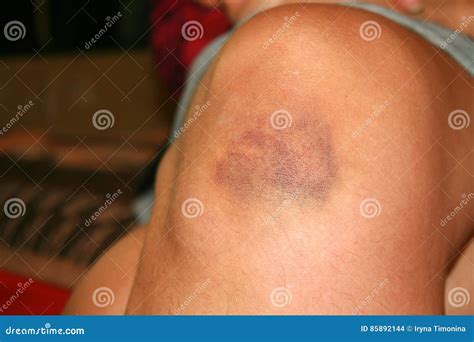 The Bruise On His Knee. The Bruise On His Leg. Stock Photography | CartoonDealer.com #85892144