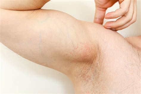 Armpit Rashes: Causes, Symptoms, Treatment, and Prevention