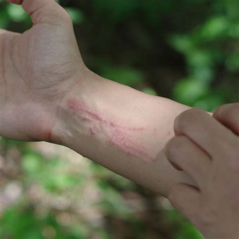 How Does Poison Ivy Spread On Your Body at Darcy Housley blog