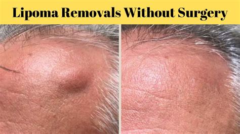 Lipoma Removal Cost