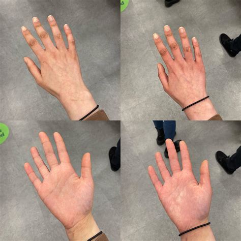 this is blood pooling right? the photos on the right are taken 1 minute after holding my hand ...