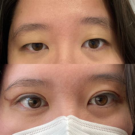 Double eyelid surgery experience online