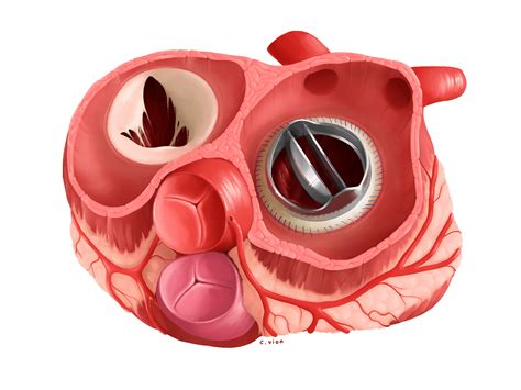 Prosthetic Mitral Valve