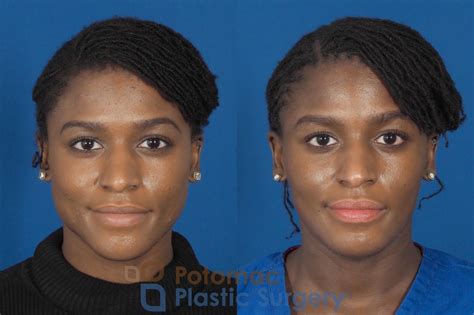 Facial Sculpting Before & After Photos Patient 300 | Washington DC & Arlington , DC | Potomac ...