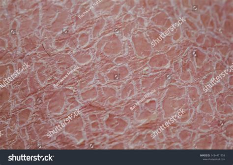 Small Scales On Skin at Stephanie Trumble blog