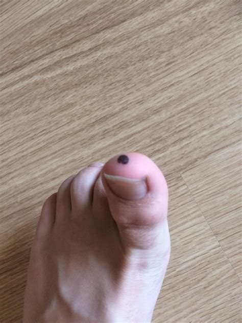 Black spot on end of toe : r/DiagnoseMe