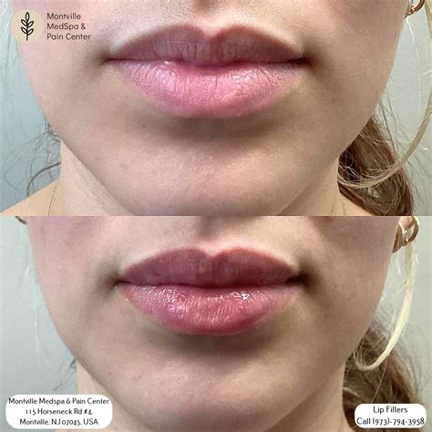 Lip Filler Techniques