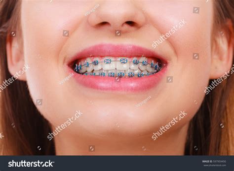 Blue Braces For Teeth