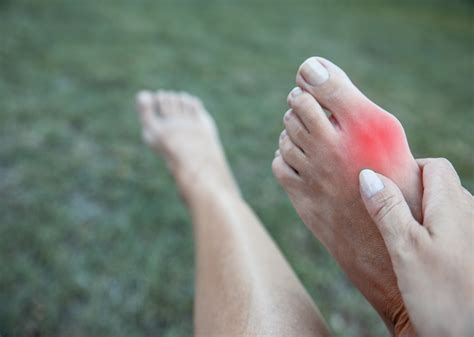 Bunions – What Causes Them and What Can I Do? | Santa Rosa Orthopaedics