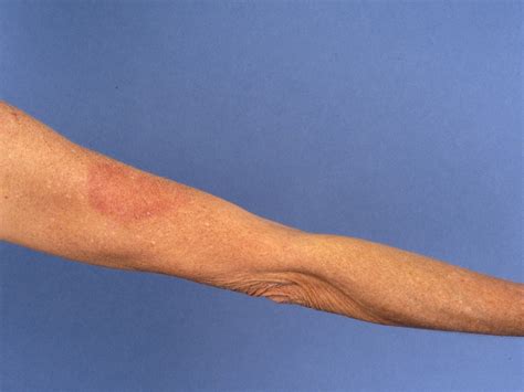 Erythema perstans