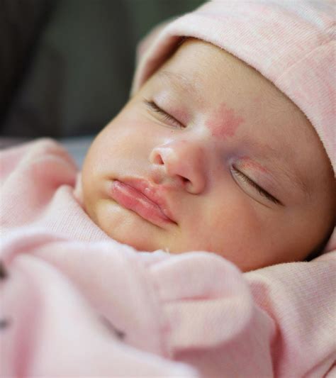 Central Cyanosis Newborn