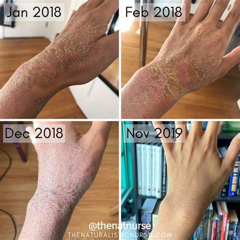 Eczema Healing Stages at Isabel Baldwin blog