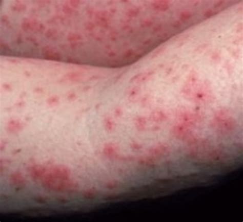 Rash On Thighs Pregnant at Juan Zuniga blog