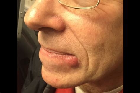 What Is The Lump On My Bottom Lip at Clifford Bloss blog
