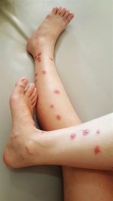 How To Treat Sea Lice Rash at Vicki Howes blog